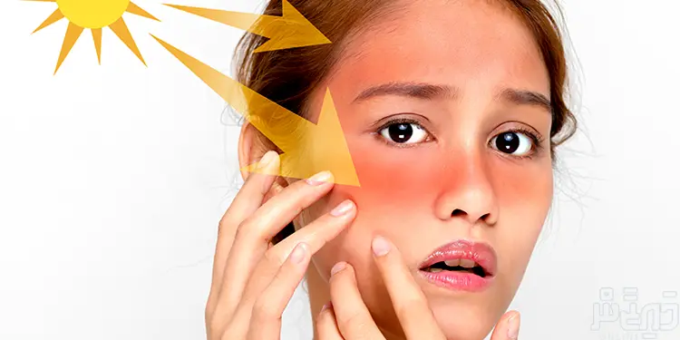 ސަންބަރން ނުވަތަ އަވިންއެނދުމުން ރައްކާތެރިވެ ގޭގައި ދެވިދާނެ ފަރުވާ